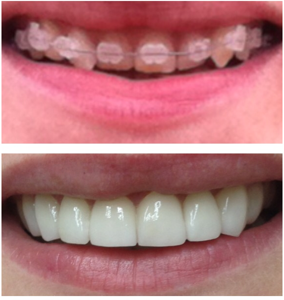 Veneers and crown