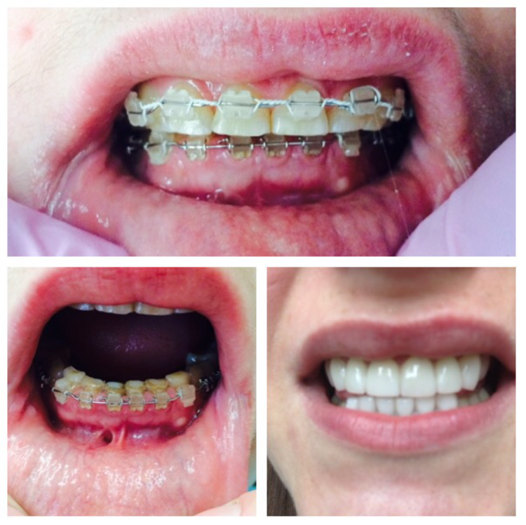 Full mouth restoration case 
