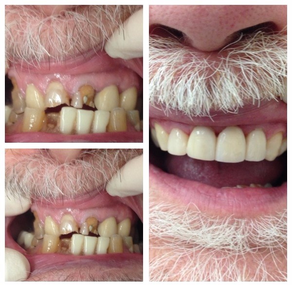 Full mouth restoration case 